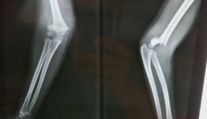 supracondylar fracture humerus