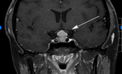  Pituitary Hyperplasia. The hyperplasia is due to primary hypothyroidism.
