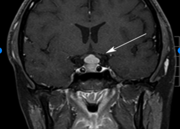  Pituitary Hyperplasia. The hyperplasia is due to primary hypothyroidism.