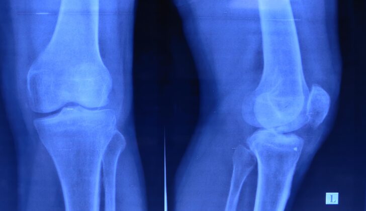 Left Knee Tibial Eminence Fracture. These anteroposterior and lateral x-ray views show a tibial eminence fracture.