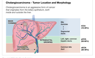 Cholangiocarcinoma Tumor Location and Morphology