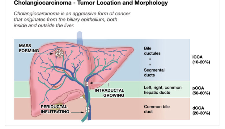 Cholangiocarcinoma Tumor Location and Morphology