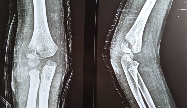 Lateral Humeral Condyle Fracture. Anteroposterior and lateral x-rays show a posteroinferiorly displaced right lateral condylar fracture postreduction.