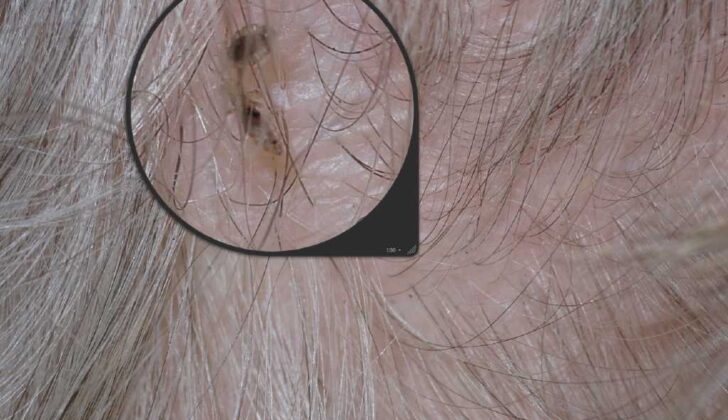 Head Lice