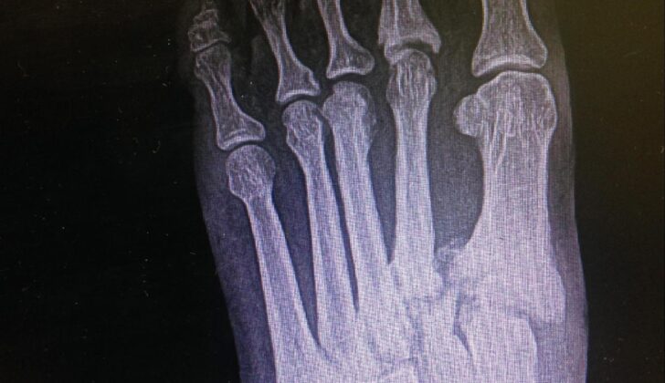 Lisfranc Dislocation. This anteroposterior left foot X-ray shows a medial tarsometatarsal fracture, disrupting the Lisfranc joint.