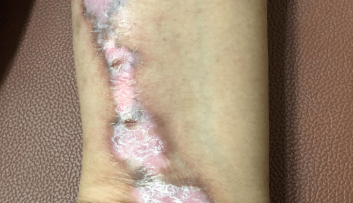 Linear Discoid Lupus Erythematosus