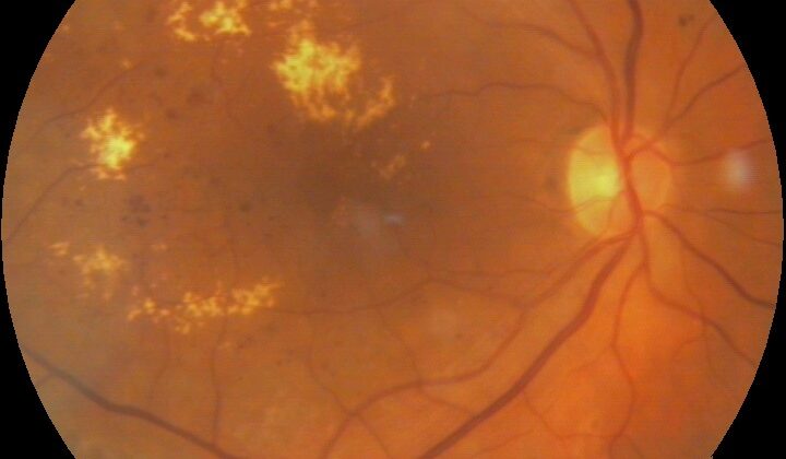 Macular Edema Associated With Diabetes.