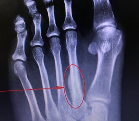 March Fracture of Second Metatarsal