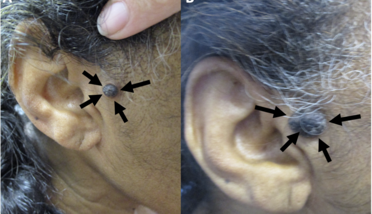 Cutaneous Melanoacanthoma on the Right Preauricular Cheek.