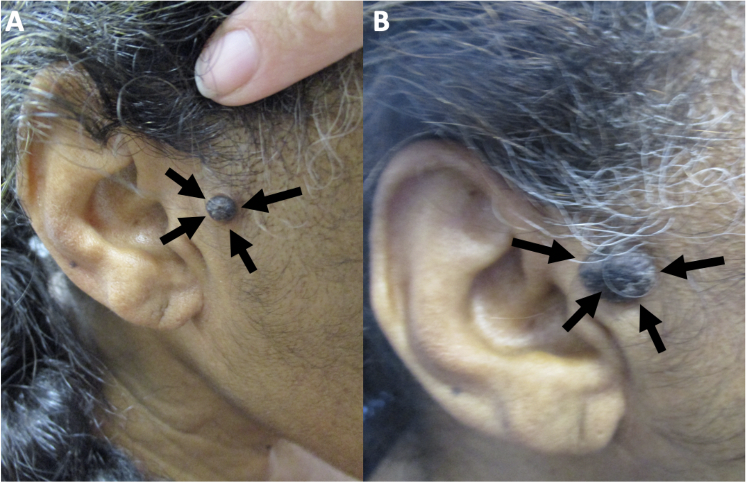 melanotic acanthoma Cutaneous Melanoacanthoma