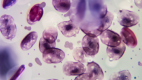 Normochromic Normocytic Anemia