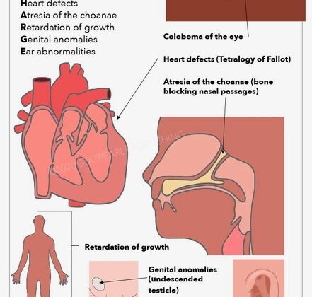 CHARGE Syndrome. The features of this condition include coloboma of the eye, heart defects, atresia of the choanae, retardation of growth, genital underdevelopment, and ear anomalies.