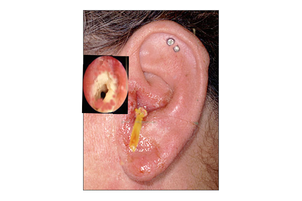 Otitis Externa. This image shows an inflamed external auditory canal with serous fluid on the tragus, auricular lobule, and antitragus, and purulent material within the canal.