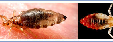Body Lice