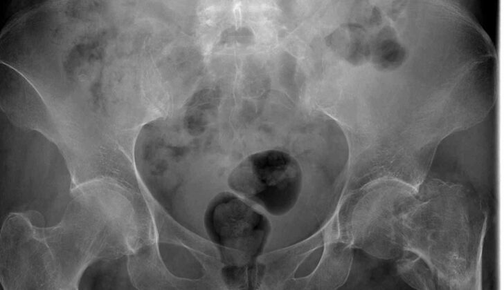 Pelvic Radiograph, Left Hip Fracture