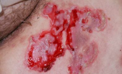 Pemphigus Vulgaris