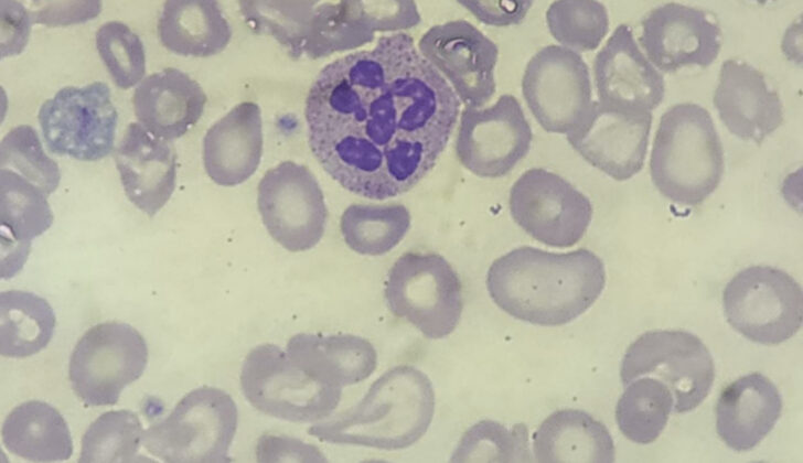 The peripheral smear shows characteristic hypersegmented neutrophil and macro ovalocytes which is found in megaloblastic anemia