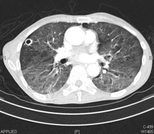 Computed Tomography of a Lung Abscess. The thick-walled cavitary lesion in the
right lung is an abscess. The diffuse ground glass infiltrates seen in both
lungs represent pneumonia.