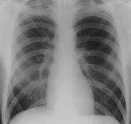Apical Ptx, Primary Spontaneous pneumothorax, X-ray