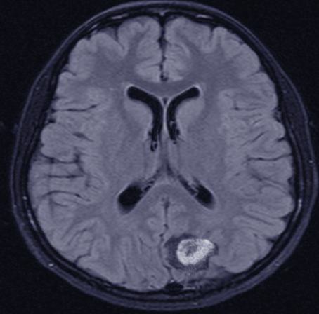 Central Nervous System Lymphoma, MRI. A magnetic resonance image of the brain
with gadolinium contrast is the recommended first test in the diagnostic workup
for patients with suspected primary central nervous lymphoma.