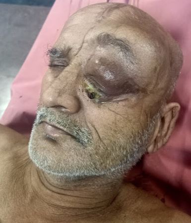 Orbito-Frontal Mass, Central Nervous System Lymphoma. This lymphoma is
recurrent. These lesions (with cranial vault involvement, soft-tissue scalp
swelling, and underlying intracranial mass) can mimic a meningioma.