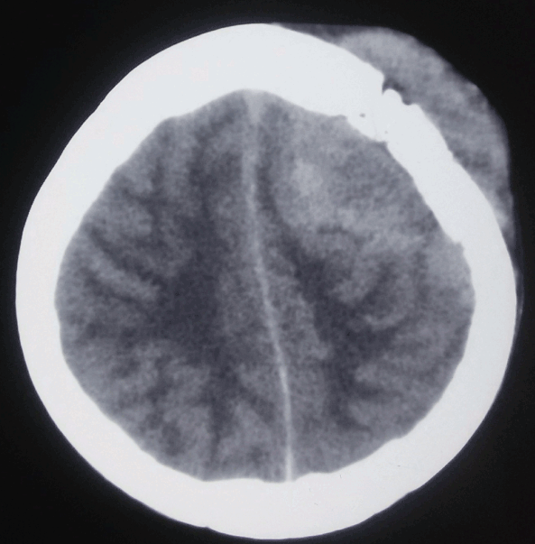 Central Nervous System Lymphoma, Hyperdense Calvarial Based Lesion. This is a
primary lymphoma, referring to isolated involvement of the craniospinal axis in
the absence of primary tumor elsewhere in the body.