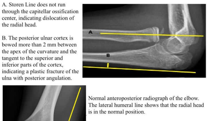 Radial Head Dislocation