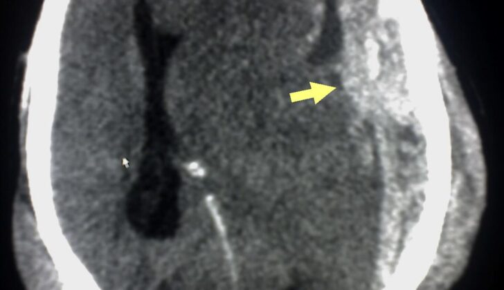 Subdural Hematoma Detected on Head CT. Abusive head trauma or shaken baby syndrome may cause subdural hematoma (arrow), indicating bleeding between the dura mater of the meninges and the brain, as detected on the head CT of a patient.
