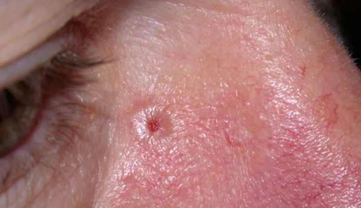Nodulocystic Basal Cell Carcinoma. The image shows nodulocystic BCC, a rarer variant that may have more than one dermoscopic face and can appear macroscopically benign.