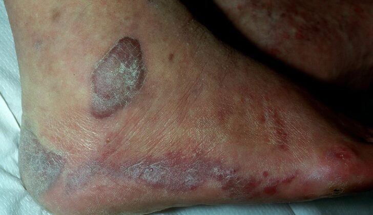 Kaposi Sarcoma
