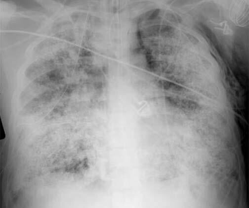 subcutaneous emphysema