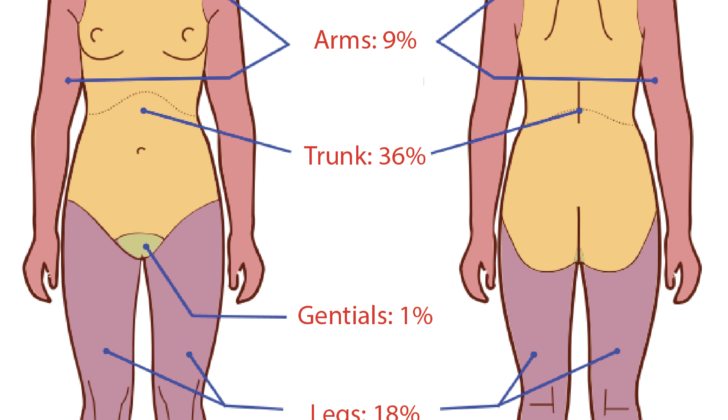 Diagram of the Rule of 9s for Adults