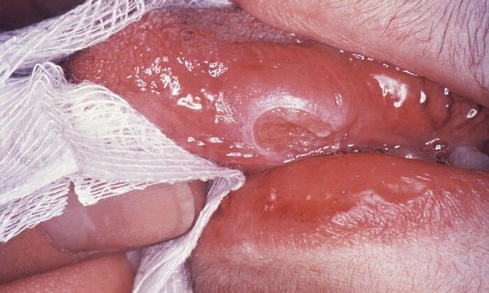 Tongue of Tuberculosis Patient. Lesion caused by Mycobacterium tuberculosis, erythematous connective tissue, eroded mucocutaneous membrane of the tongue.