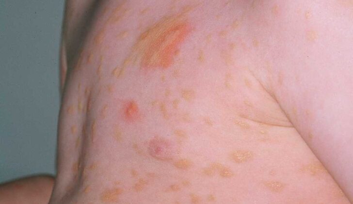 Urticaria Pigmentosa
