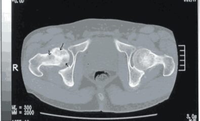 Dysbaric Osteonecrosis, CT scan