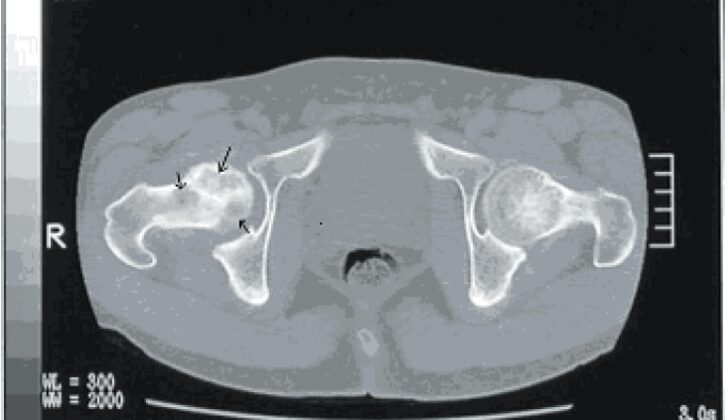 Dysbaric Osteonecrosis, CT scan