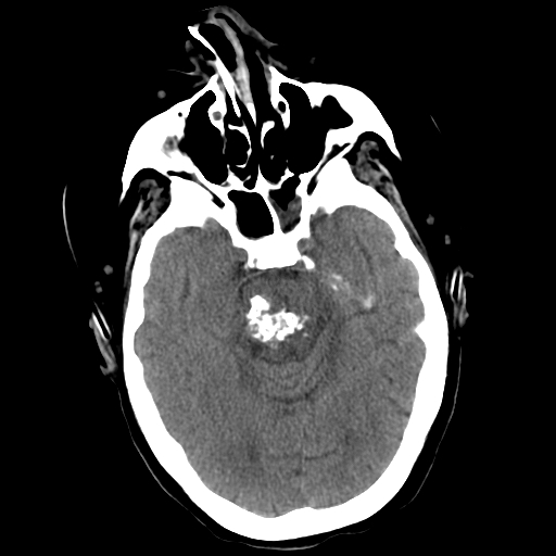 Head CT, Pons Cavernoma