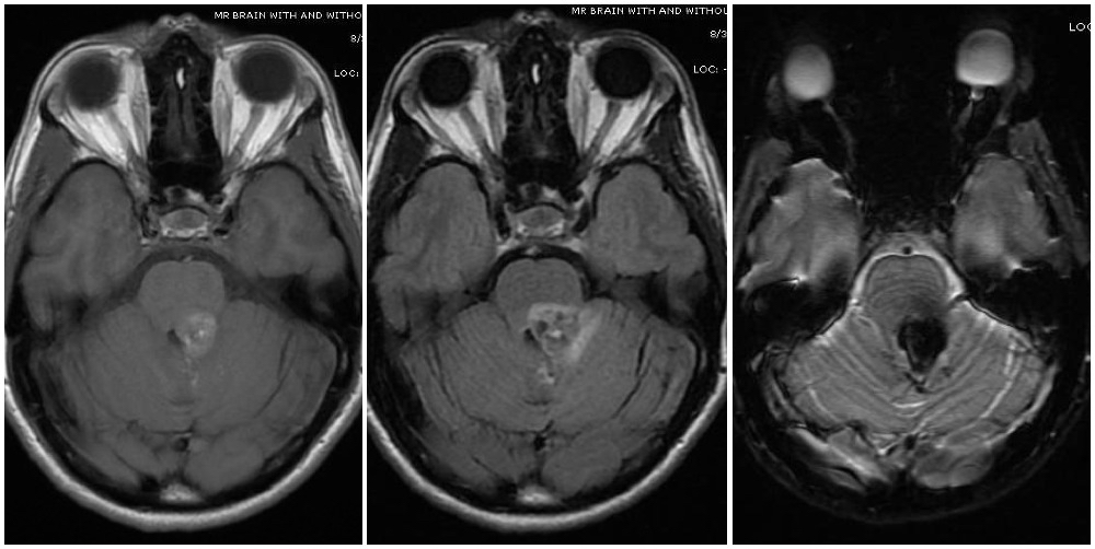 Magnetic resonance imaging depicts a cavernous malformation in the left middle
cerebellar peduncle of a patient who presented with right sided facial numbness
and ataxia. Varying signal intensities on T1- and T2-weighted sequences and
detection of blood on susceptibility weighted sequences (left, middle, and right
images, respectively) that are characteristic for a cavernoma are seen. Imaging
findings consistent with a Zabramski type 2 cavernoma with mixed signal
intensities on both type 1 and type 2, giving it the
