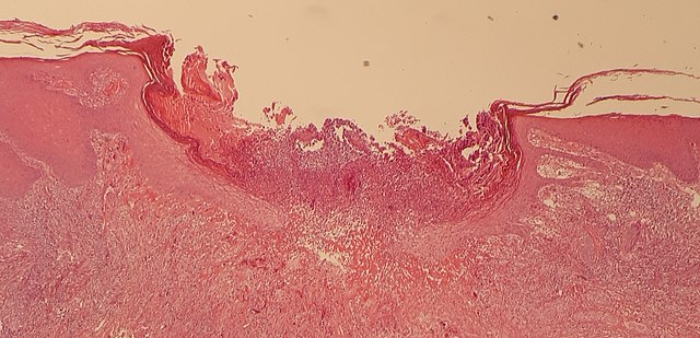 Histopathology of chondrodermatitis nodularis chronica helicis. There is an ulceration surrounded by acanthosis and parakeratosis, with absence of atypia.