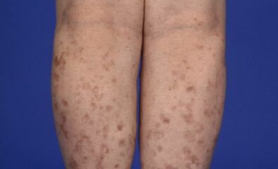 Disseminated Superficial Actinic Porokeratosis (DSAP)
