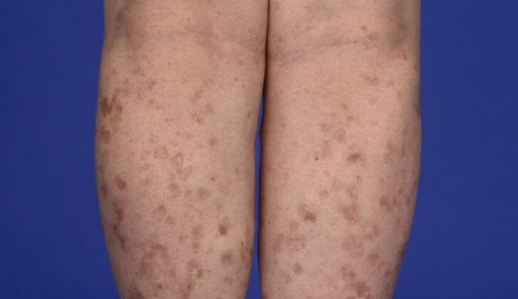 Disseminated Superficial Actinic Porokeratosis (DSAP)
