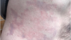 Decompression Sickness Rash. Another photograph of the rash on patient’s torso, a closer view.