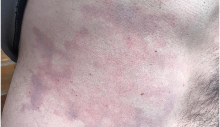 Decompression Sickness Rash. Another photograph of the rash on patient’s torso, a closer view.