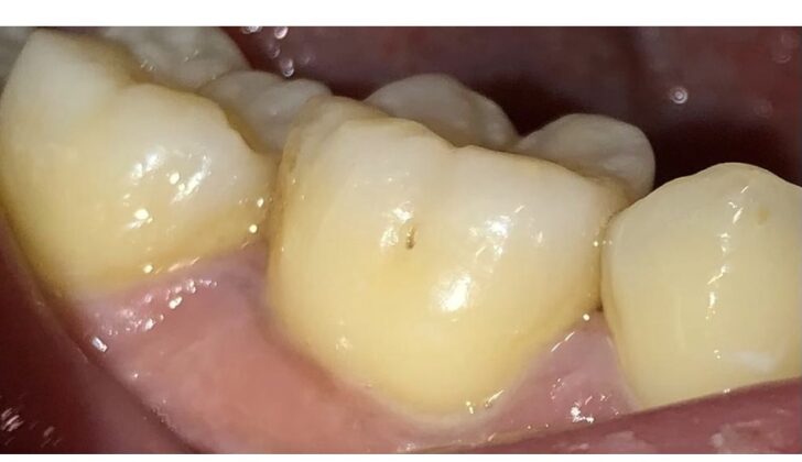 Inactive initial lesion in the pit of 46.