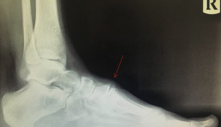 Anterior Tarsal Tunnel Syndrome from Osteophyte Formation. This x-ray shows dorsal soft tissue swelling and osteophyte formation on the metatarsal-cuneiform joint, causing medial dorsal cutaneous nerve entrapment and distal paresthesias.