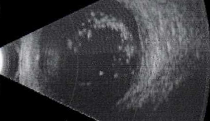 Ultrasound B-Scan image of an eye with asteroid hyalosis. Please note the dot echoes in the vitreous cavity and a clear zone between the dot echoes and the retina.