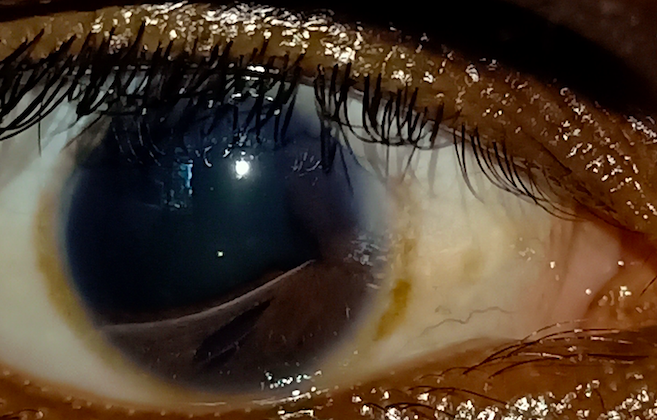 The slit lamp image of the patient depicts posterior embryotoxon, moderate anterior chamber depth, correctopia, polycoria, early iris atrophy, and iris mammillations.