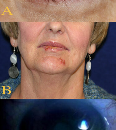 Herpes Simplex Keratitis Clinical Features. Various clinical findings of herpetic keratitis are demonstrated. In image A (top), herpetic keratitis with neovascularization of the cornea is noted. In image B (middle), HSV type 1 lesions are seen on the patient's lips and chin. Image C (bottom) demonstrates findings of stage 1 neurotrophic keratitis, including fluorescein epithelial staining with Gaule spots, which are scattered areas of dried epithelium.