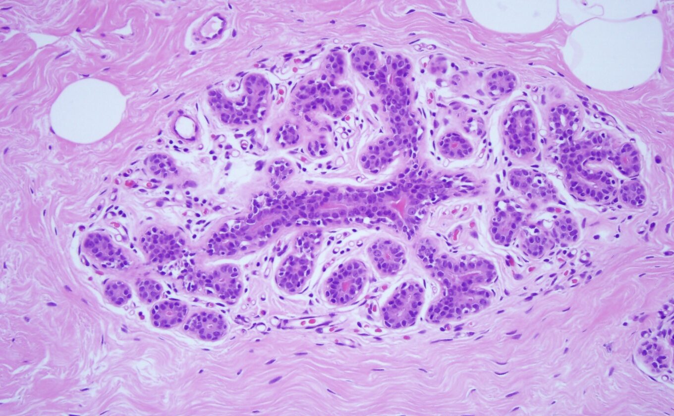 Breast Ductal Carcinoma in Situ - MD Searchlight