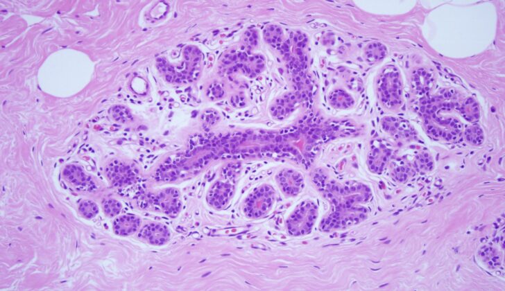 Microscopic anatomy of normal female breast tissue showing a terminal duct lobular unit (TDLU) . The ducts and lobules lumens are open as the epithelial cells do not distend them. Note the epithelial nuclei are overlapping, small, round, and the nucleoli are inconspicuous, consistent with benign breast tissue (x10).